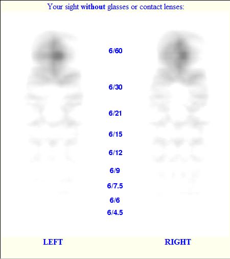 Myopia Prescription Chart