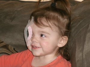 picture of toddler girl with glaucoma and cataracts